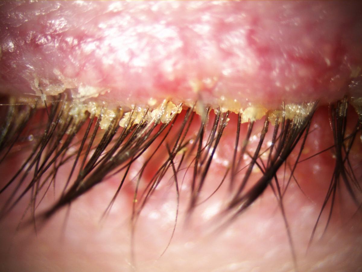 demodex evolution eyelid