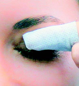 chalazion et bague en or chalazion et bague en or