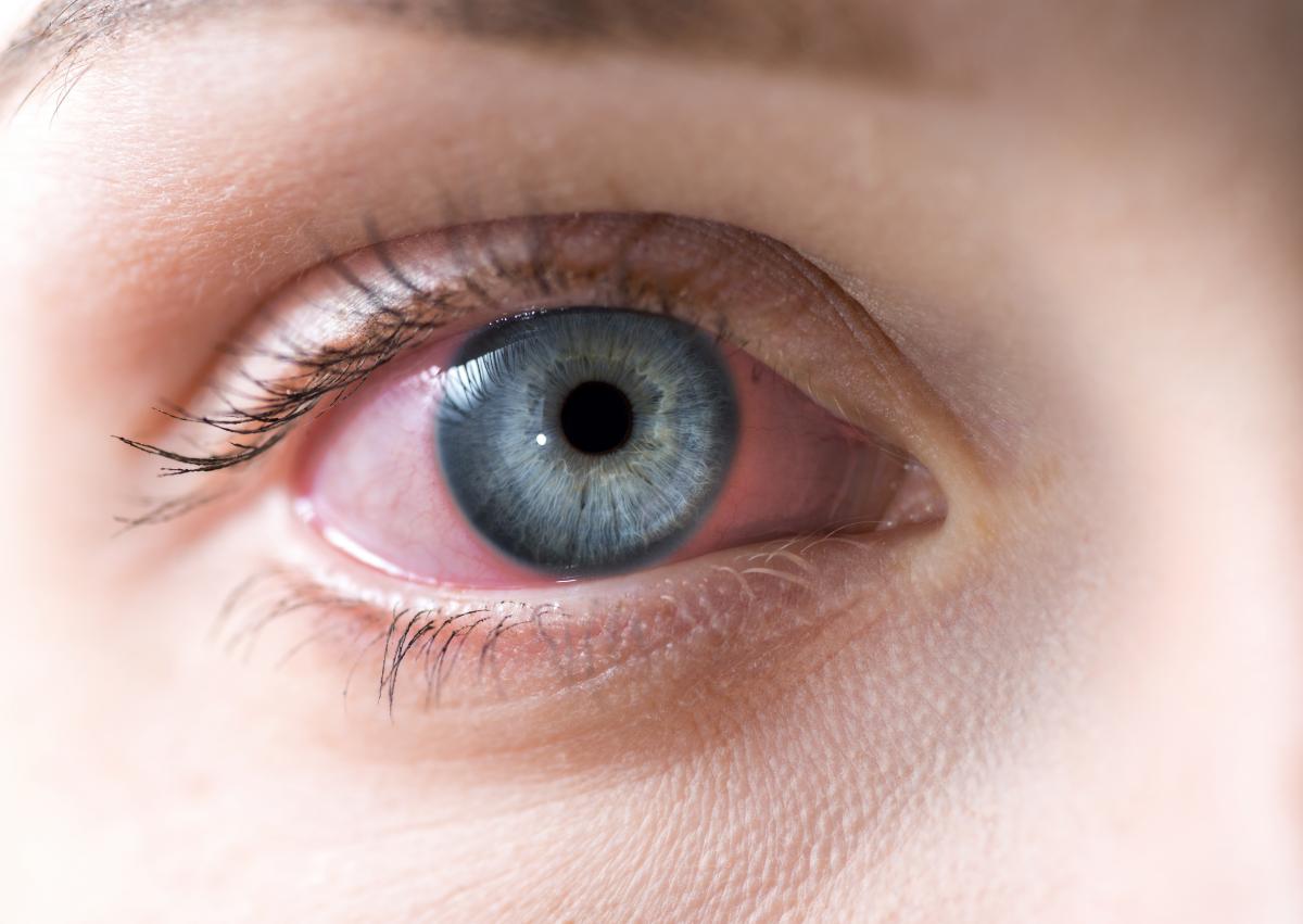 Bloodshot Eyes: Should you be concerned?