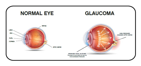 Glaucoma - zöldhályog