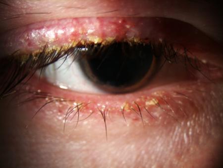 Demodex
