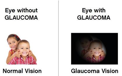 Glaucoma Glaucoma