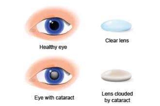 Cataract